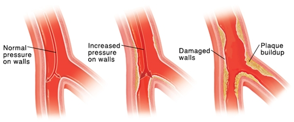 ▲ 혈압이 높으면 심장이 더 많은 일을 해야 하기 때문에 심장에 변형이 오기 쉽고 혈관은 높은 압력 때문에 손상이 쉽게 온다.